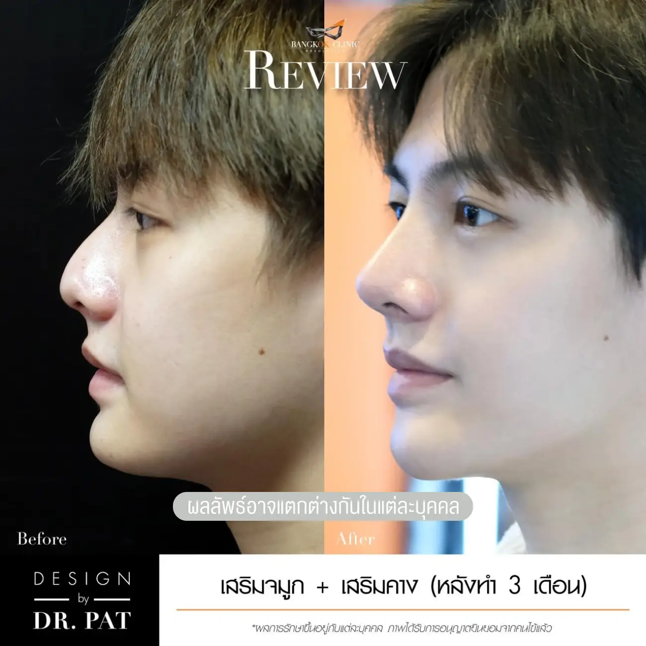 รีวิวทำจมูก เสริมจมูกผู้ชาย ที่ Bangkok Clinic & Design by Dr. Pat รูป 2