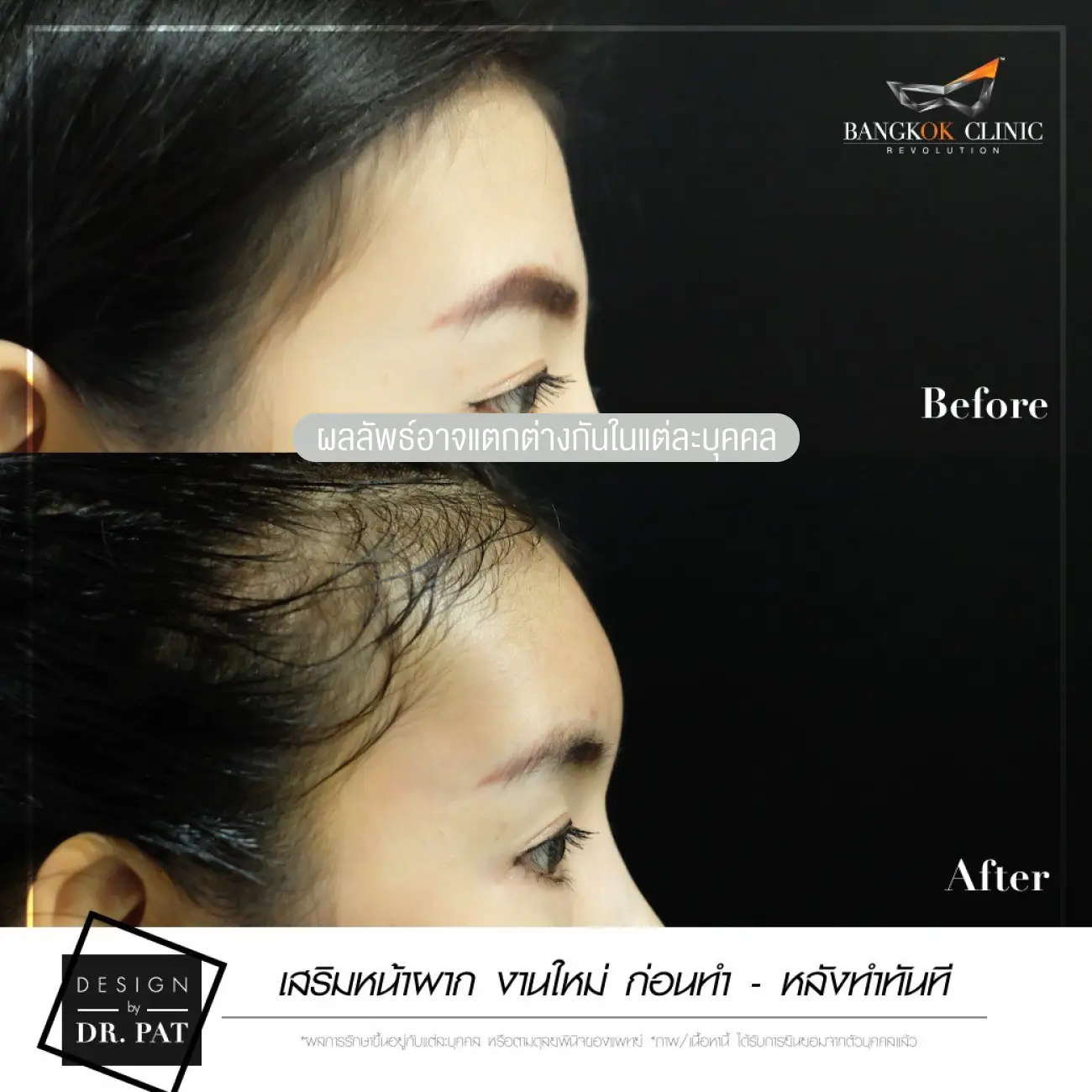 รีวิวทำหน้าผาก เสริมหน้าผาก ที่ Bangkok Clinic & Design by Dr. Pat รูปที่ 2