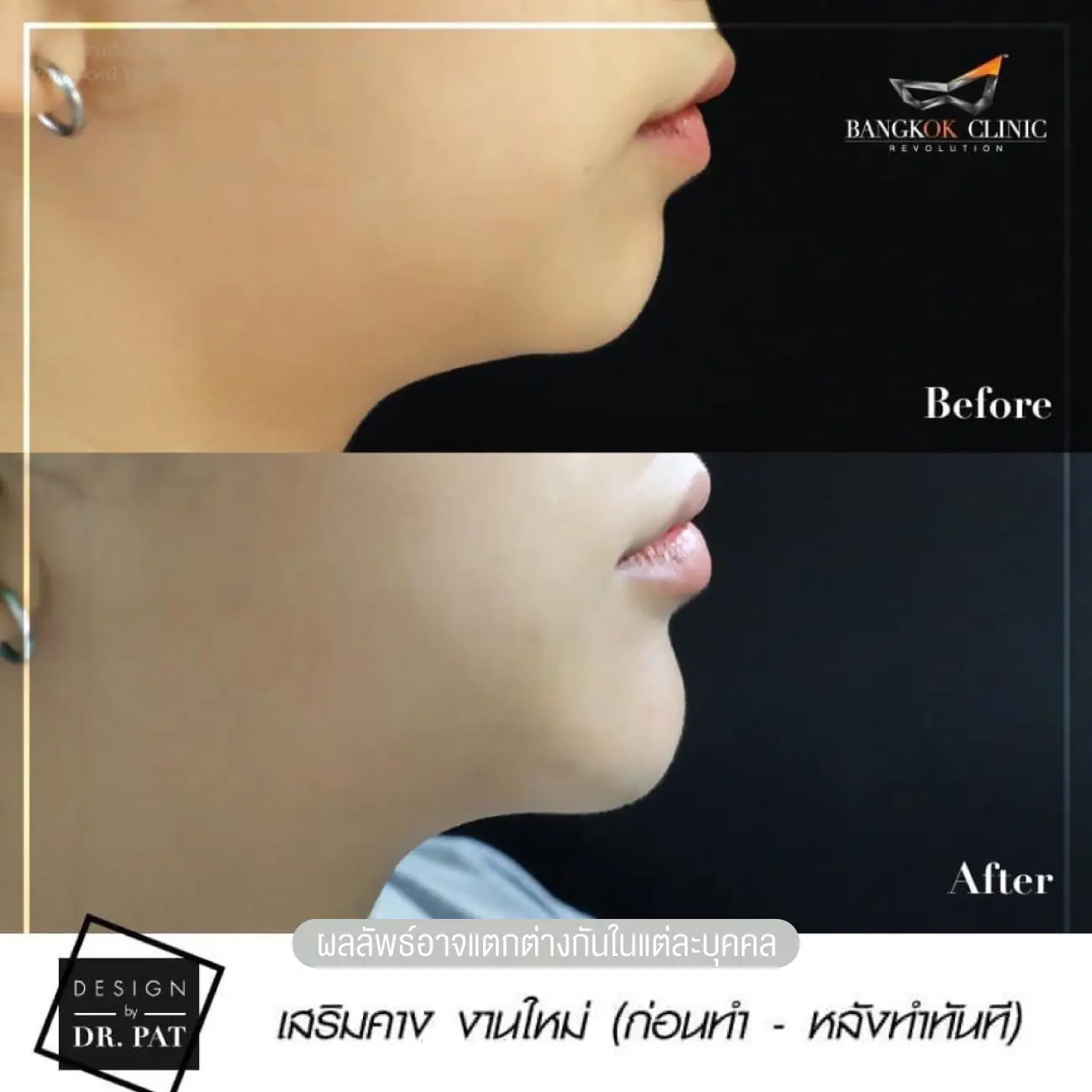 รีวิวทำคาง เสริมคางผู้หญิง ที่ Bangkok Clinic & Design by Dr. Pat รูปที่ 2