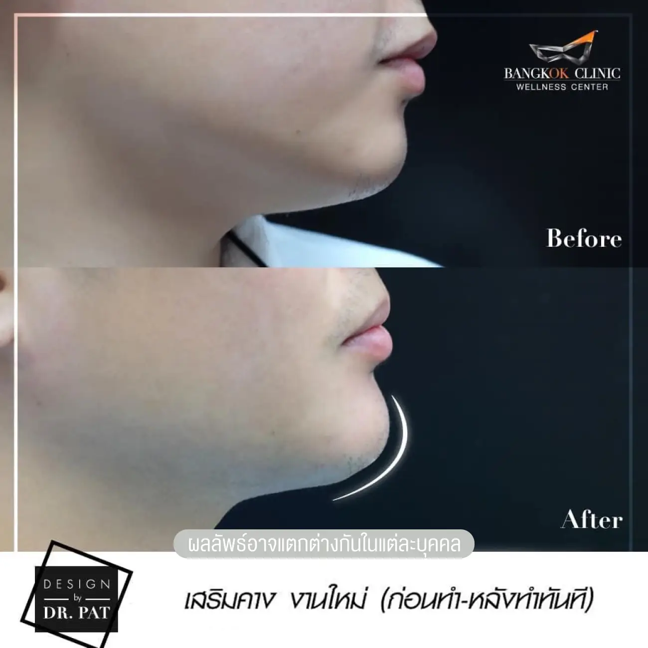 รีวิวทำคาง เสริมคางผู้ชาย ที่ Bangkok Clinic & Design by Dr. Pat รูปที่ 3