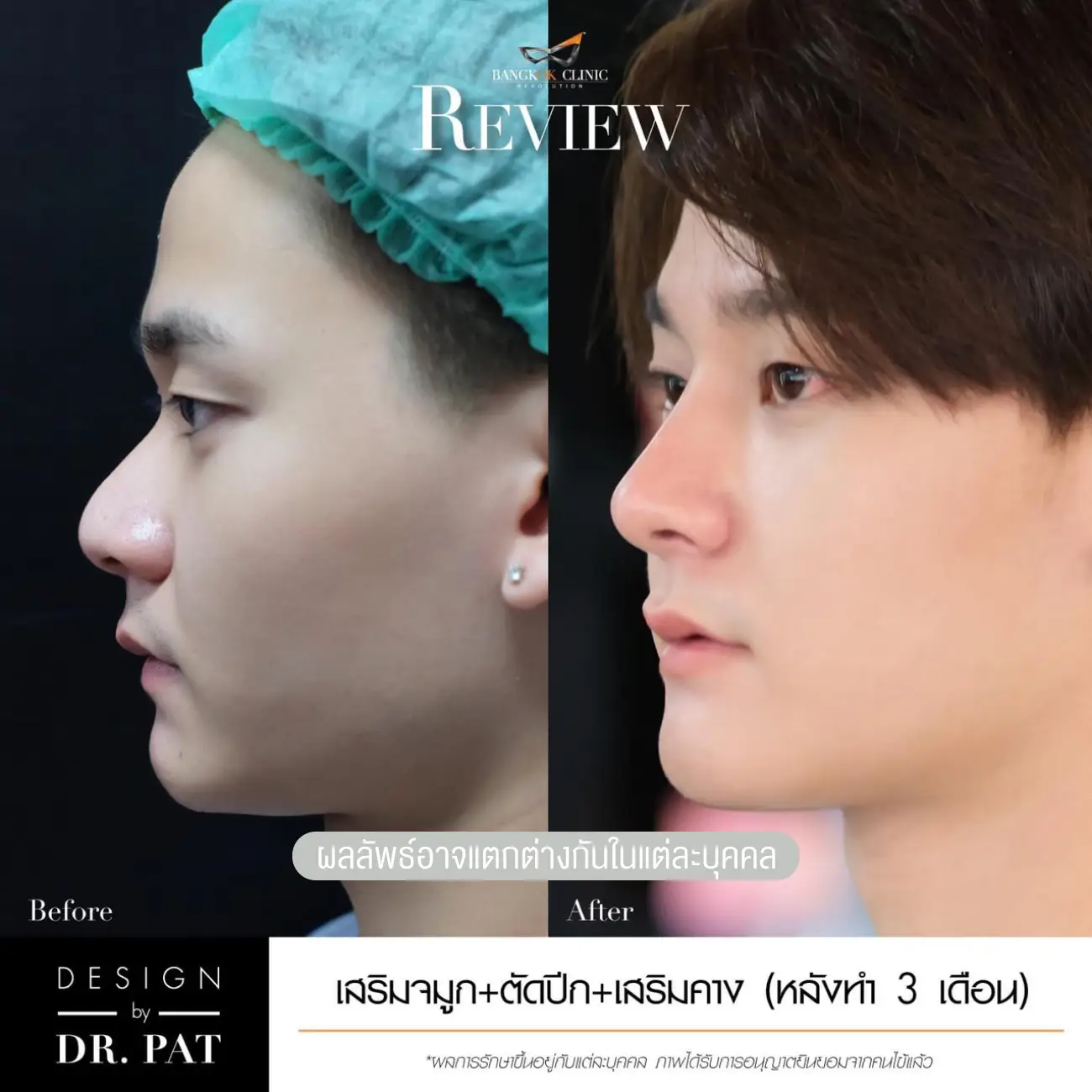 รีวิวทำจมูก เสริมจมูกผู้ชาย ที่ Bangkok Clinic & Design by Dr. Pat รูป 3