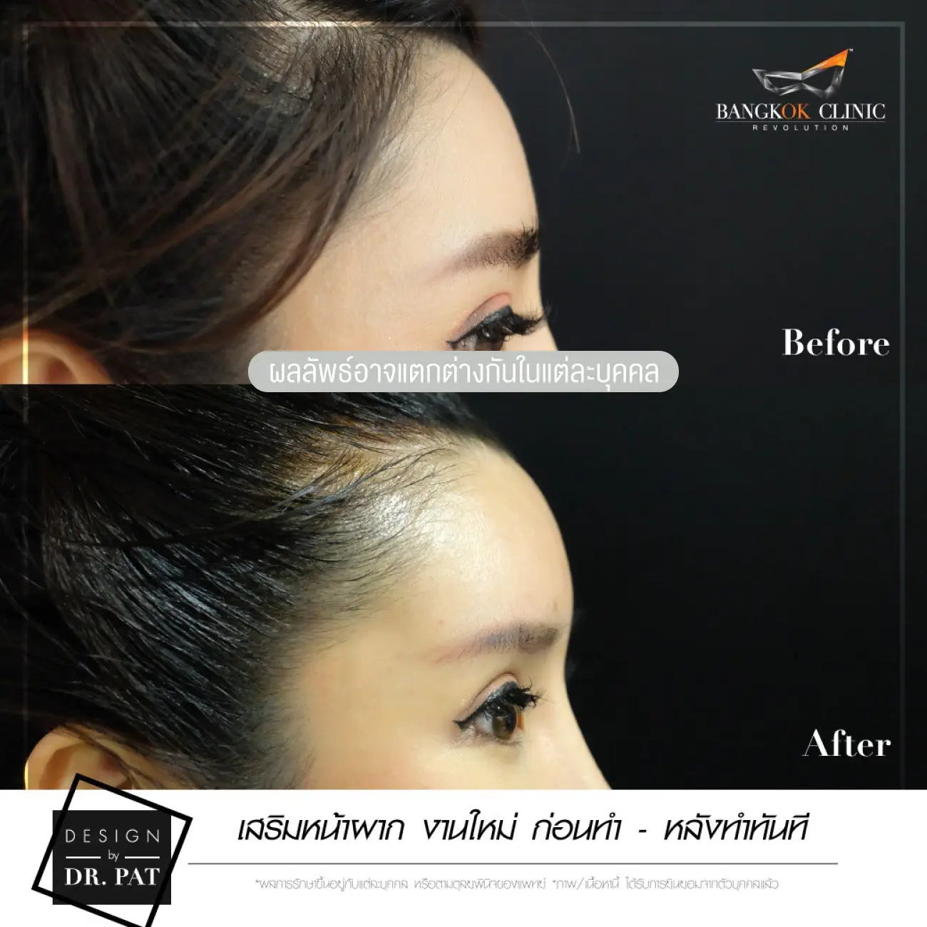 รีวิวทำหน้าผาก เสริมหน้าผาก ที่ Bangkok Clinic & Design by Dr. Pat รูปที่ 3