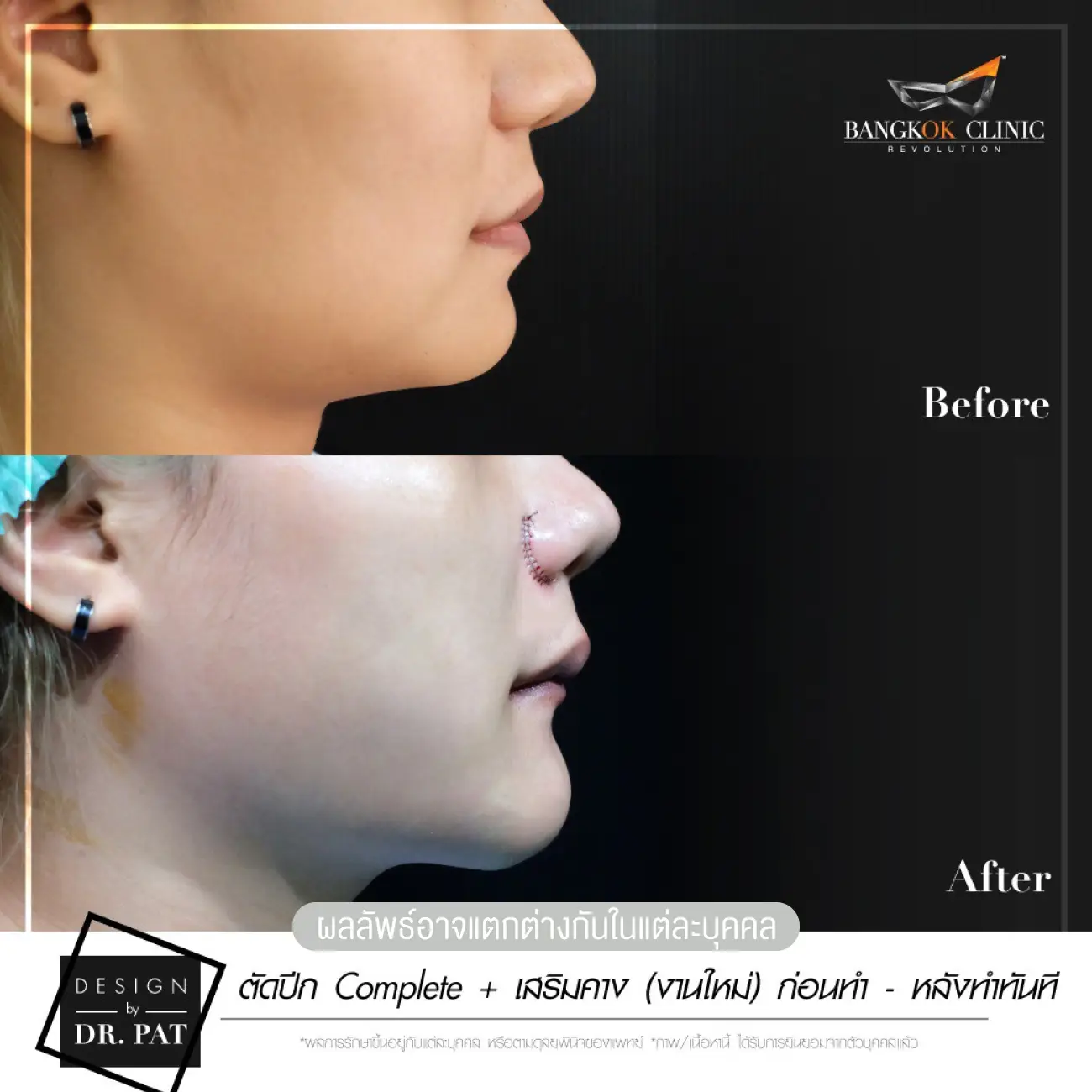 รีวิวทำคาง เสริมคางผู้หญิง ที่ Bangkok Clinic & Design by Dr. Pat รูปที่ 3