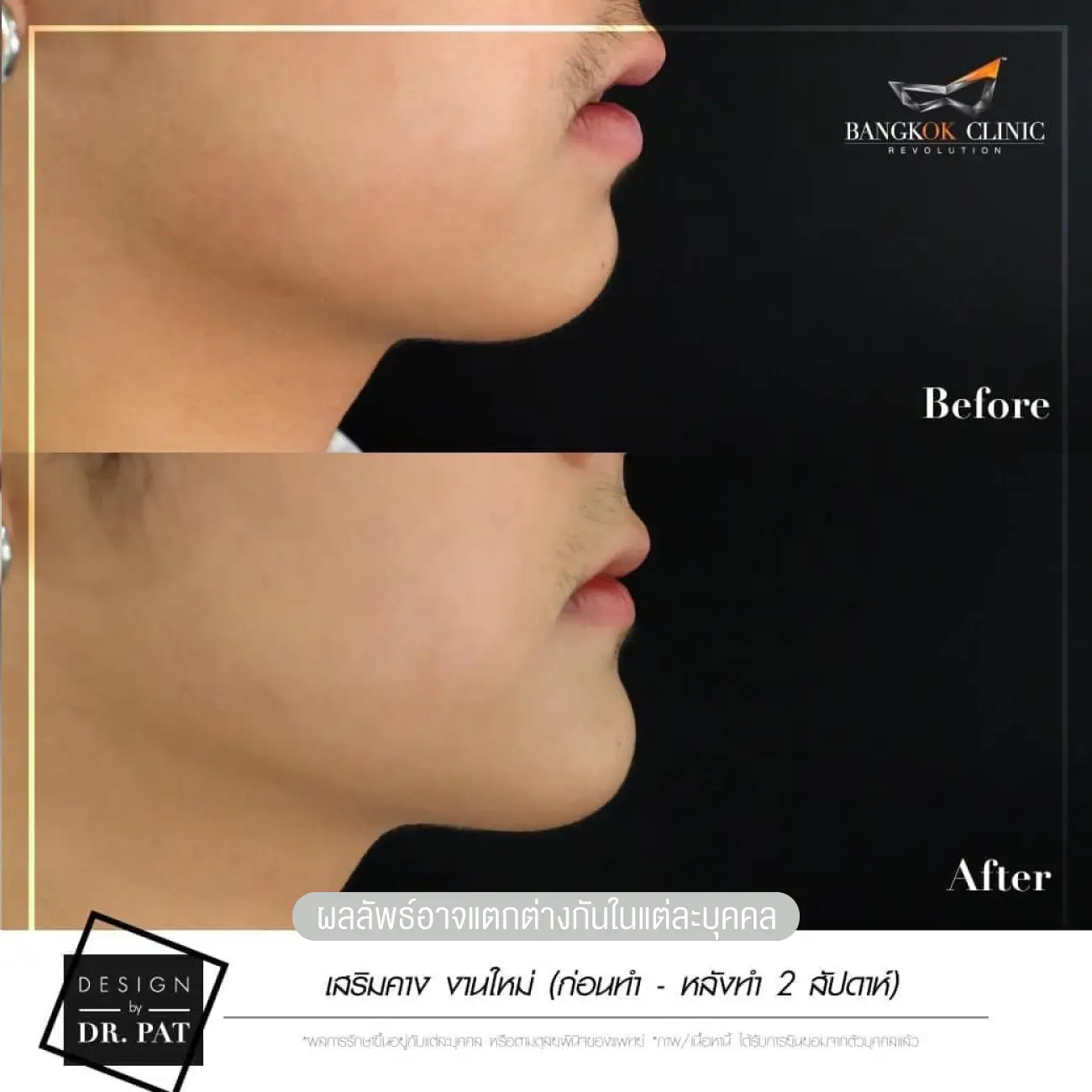 รีวิวทำคาง เสริมคางผู้ชาย ที่ Bangkok Clinic & Design by Dr. Pat รูปที่ 4