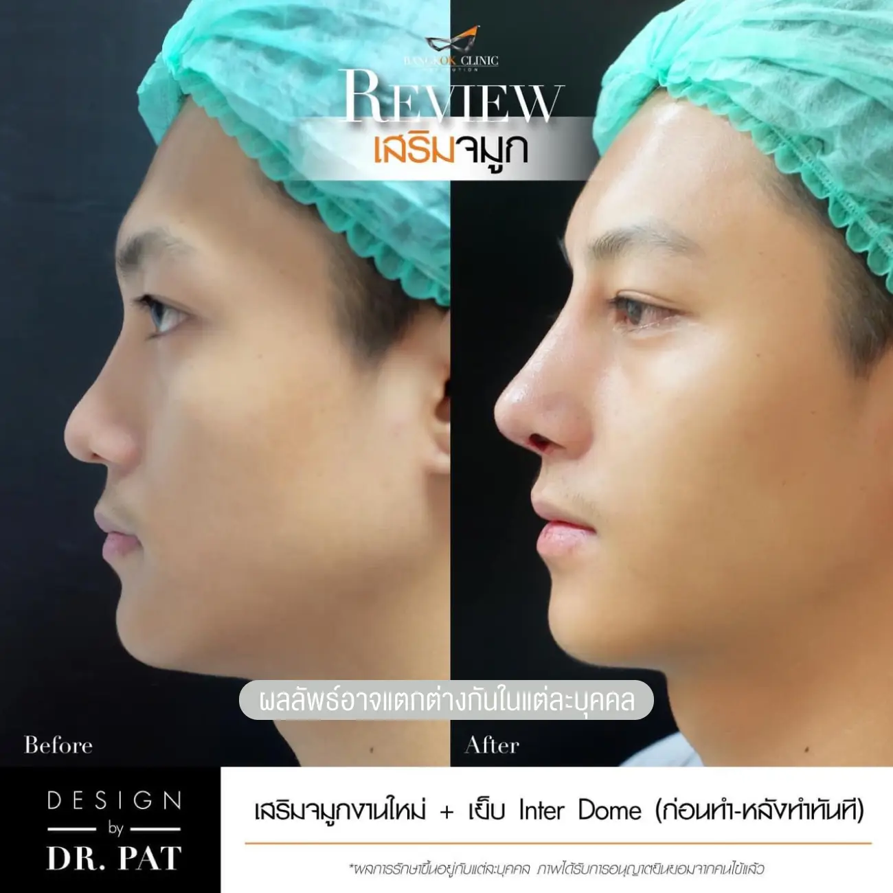 รีวิวทำจมูก เสริมจมูกผู้ชาย ที่ Bangkok Clinic & Design by Dr. Pat รูป 4