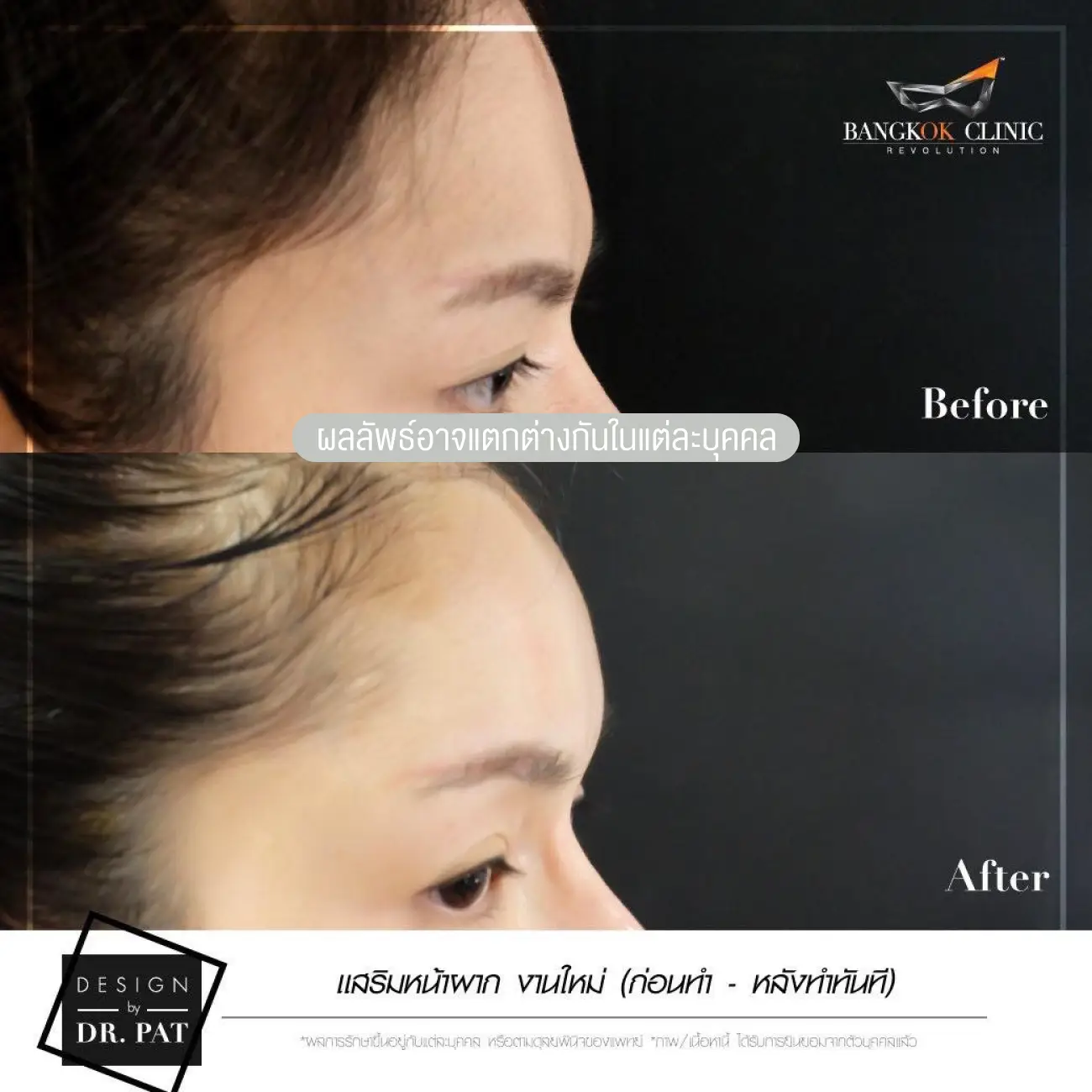 รีวิวทำหน้าผาก เสริมหน้าผาก ที่ Bangkok Clinic & Design by Dr. Pat รูปที่ 4