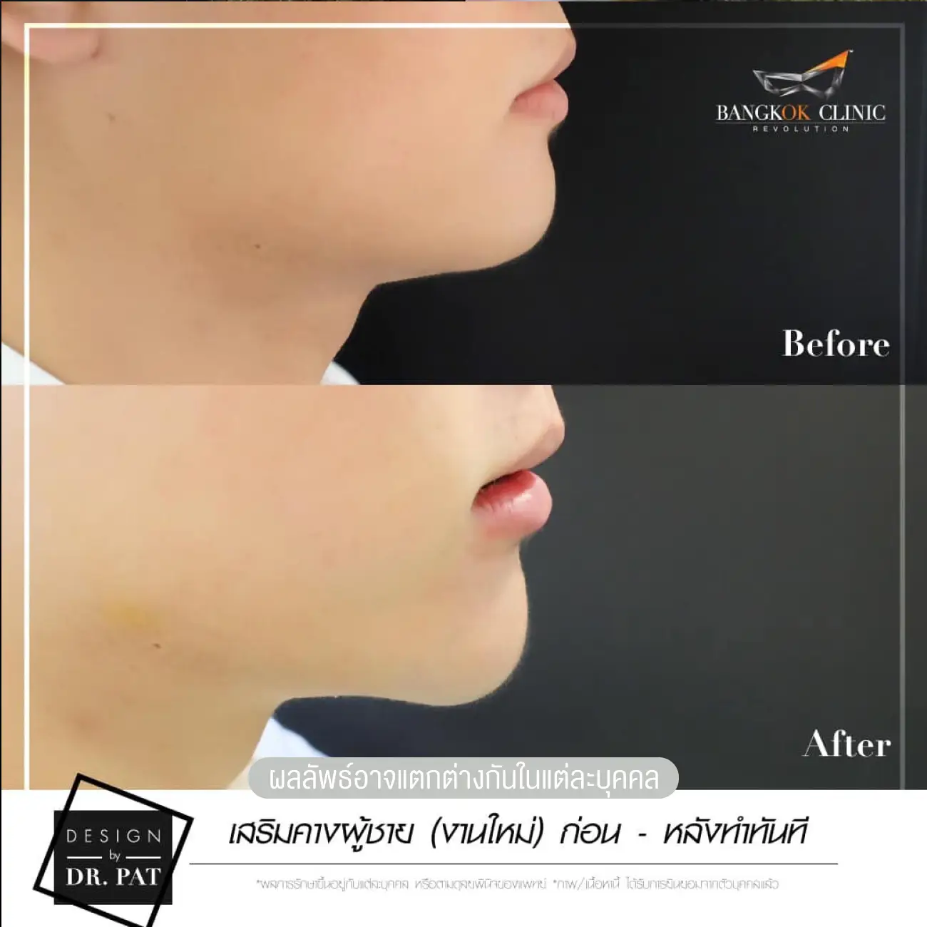 รีวิวทำคาง เสริมคางผู้ชาย ที่ Bangkok Clinic & Design by Dr. Pat รูปที่ 5