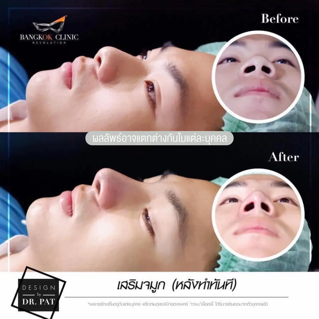 รีวิวทำจมูก เสริมจมูกผู้ชาย ที่ Bangkok Clinic & Design by Dr. Pat รูป 5