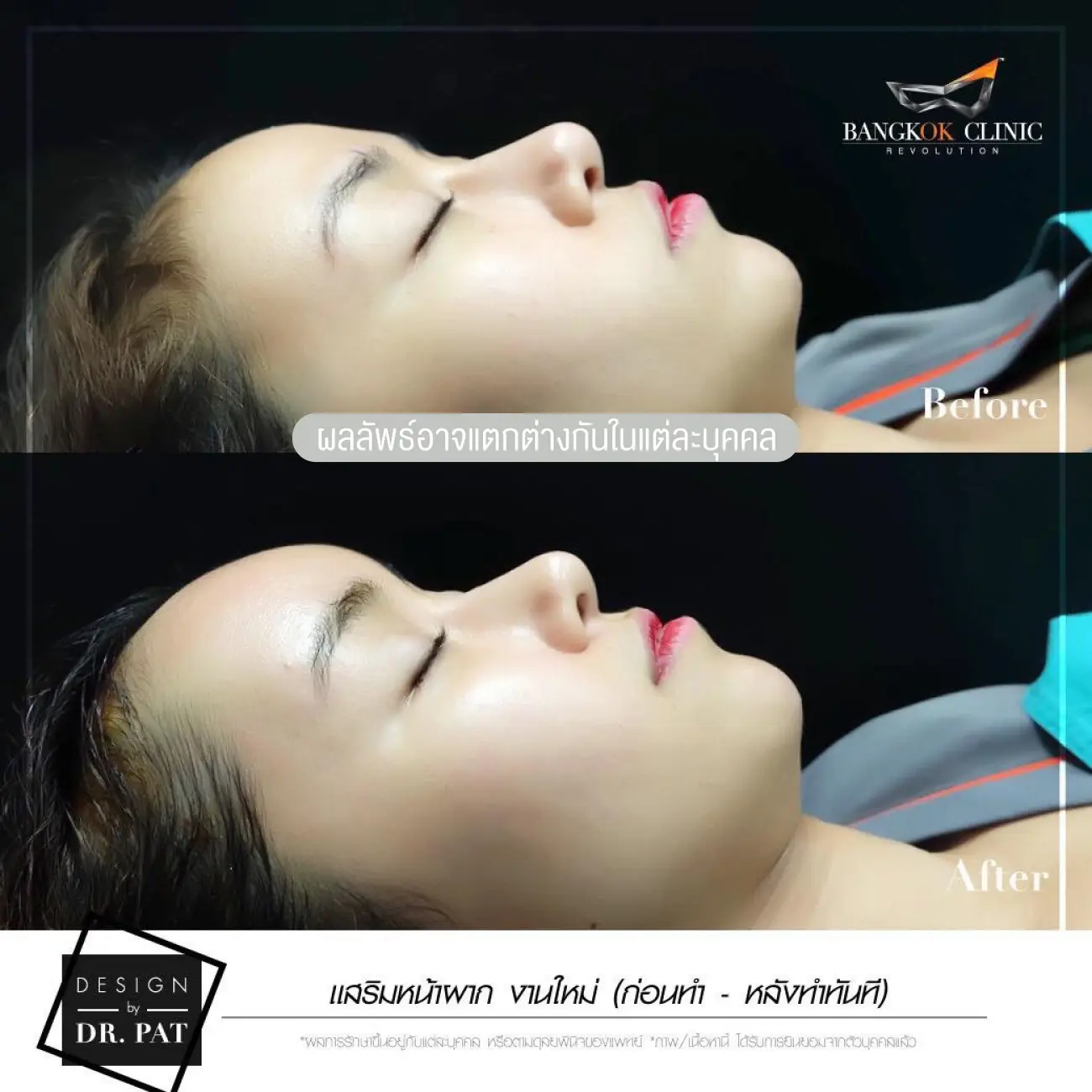 รีวิวทำหน้าผาก เสริมหน้าผาก ที่ Bangkok Clinic & Design by Dr. Pat รูปที่ 5