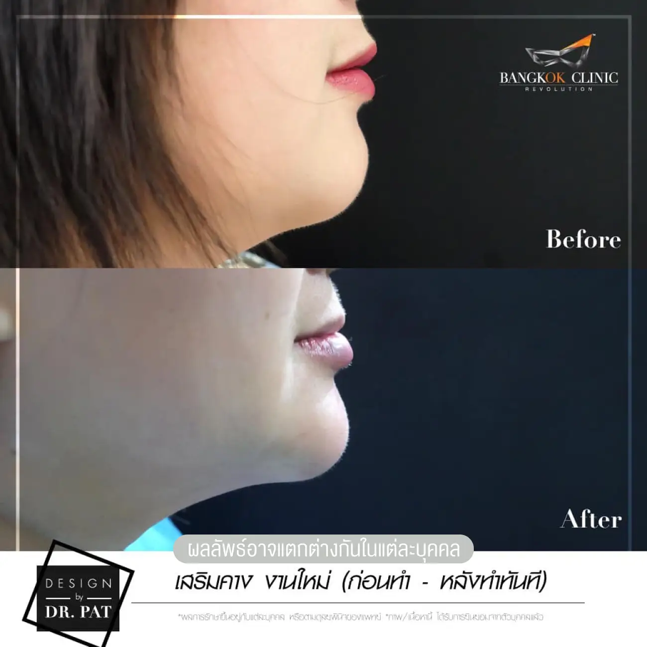 รีวิวทำคาง เสริมคางผู้หญิง ที่ Bangkok Clinic & Design by Dr. Pat รูปที่ 5