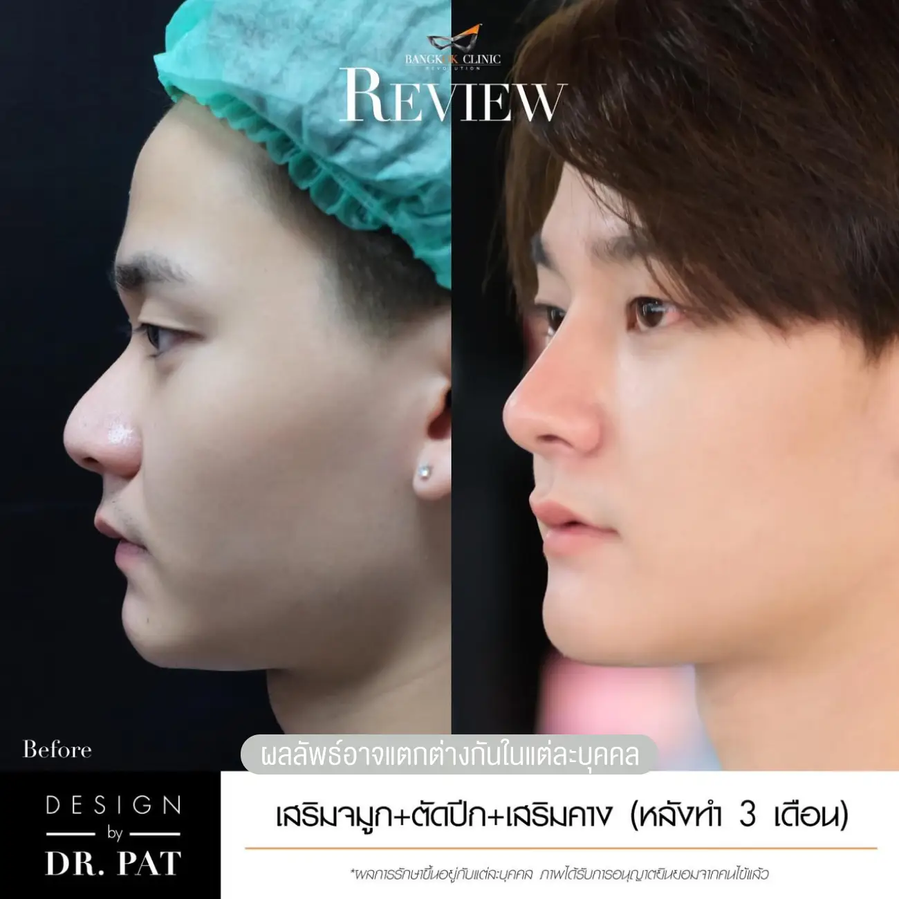 รีวิวทำคาง เสริมคางผู้ชาย ที่ Bangkok Clinic & Design by Dr. Pat รูปที่ 6