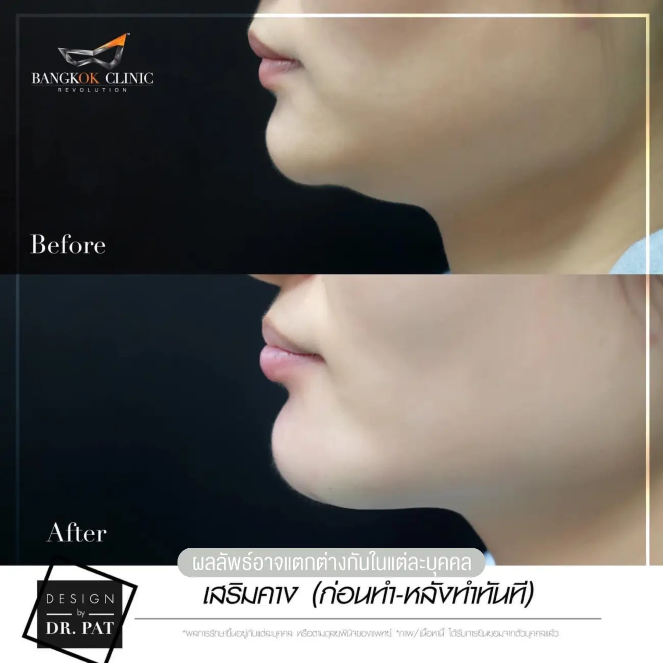 รีวิวทำคาง เสริมคางผู้หญิง ที่ Bangkok Clinic & Design by Dr. Pat รูปที่ 6