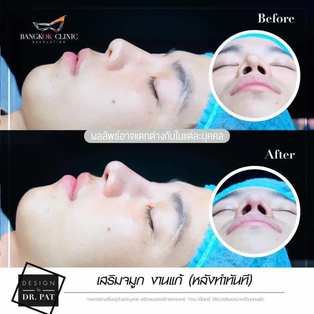 รีวิวทำจมูก เสริมจมูกผู้ชาย ที่ Bangkok Clinic & Design by Dr. Pat รูป 6