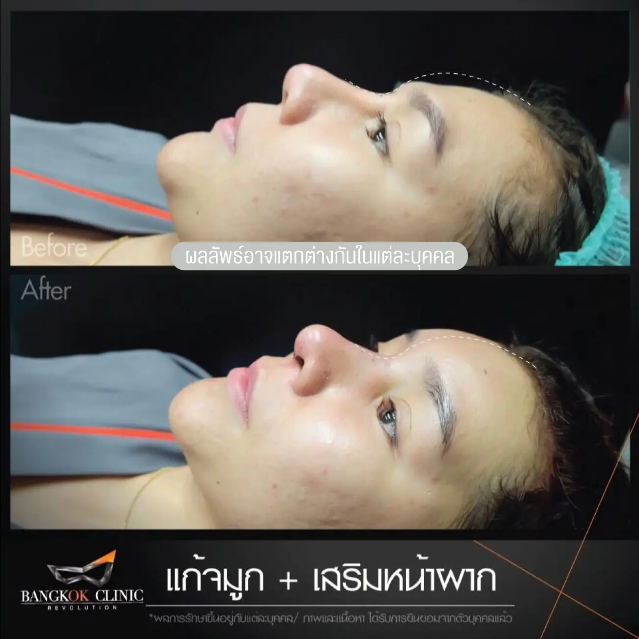 รีวิวทำหน้าผาก เสริมหน้าผาก ที่ Bangkok Clinic & Design by Dr. Pat รูปที่ 6