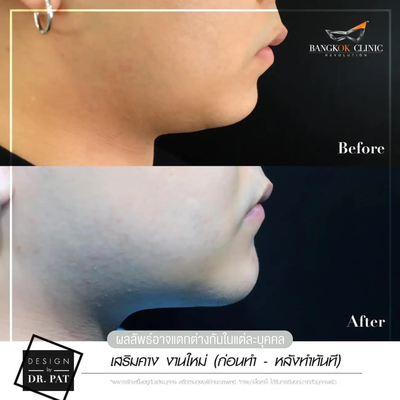 รีวิวทำคาง เสริมคางผู้หญิง ที่ Bangkok Clinic & Design by Dr. Pat รูปที่ 7