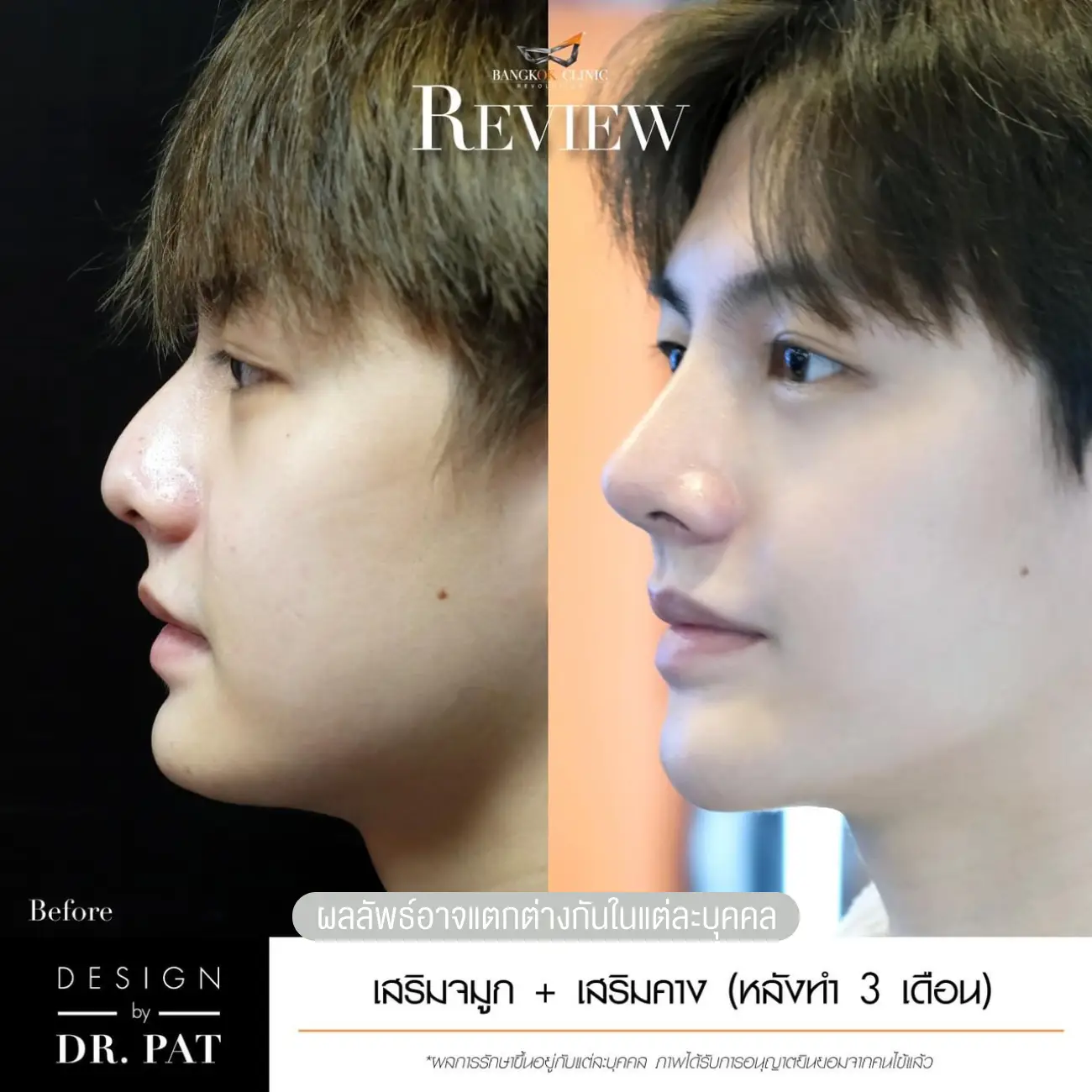 รีวิวทำคาง เสริมคางผู้ชาย ที่ Bangkok Clinic & Design by Dr. Pat รูปที่ 7