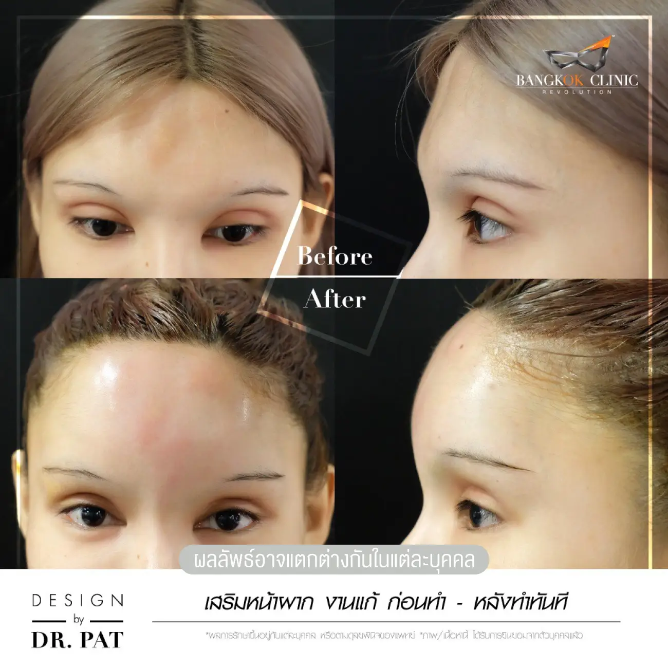 รีวิวทำหน้าผาก เสริมหน้าผาก ที่ Bangkok Clinic & Design by Dr. Pat รูปที่ 7