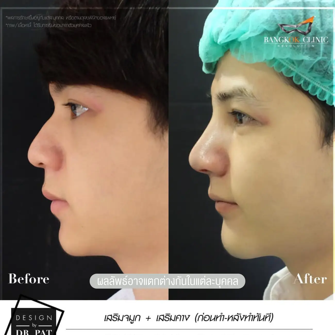 รีวิวทำคาง เสริมคางผู้ชาย ที่ Bangkok Clinic & Design by Dr. Pat รูปที่ 8