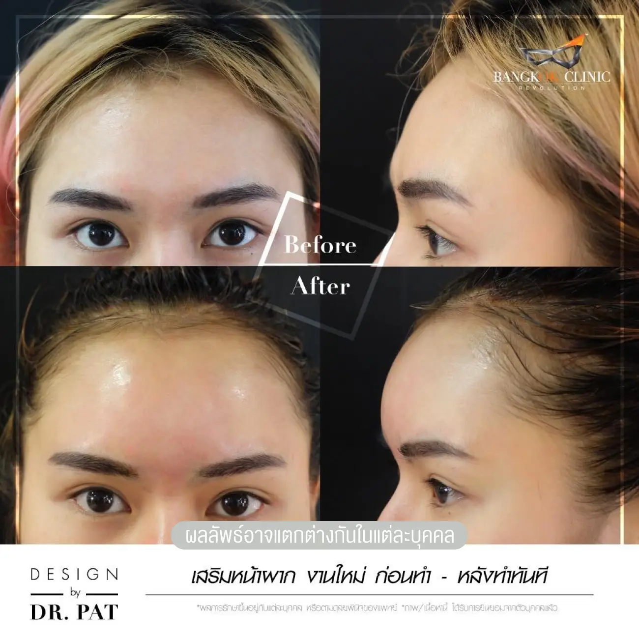 รีวิวทำหน้าผาก เสริมหน้าผาก ที่ Bangkok Clinic & Design by Dr. Pat รูปที่ 8