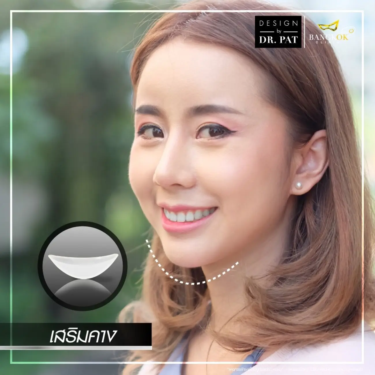 รีวิวทำคาง เสริมคางผู้หญิง ที่ Bangkok Clinic & Design by Dr. Pat รูปที่ 9