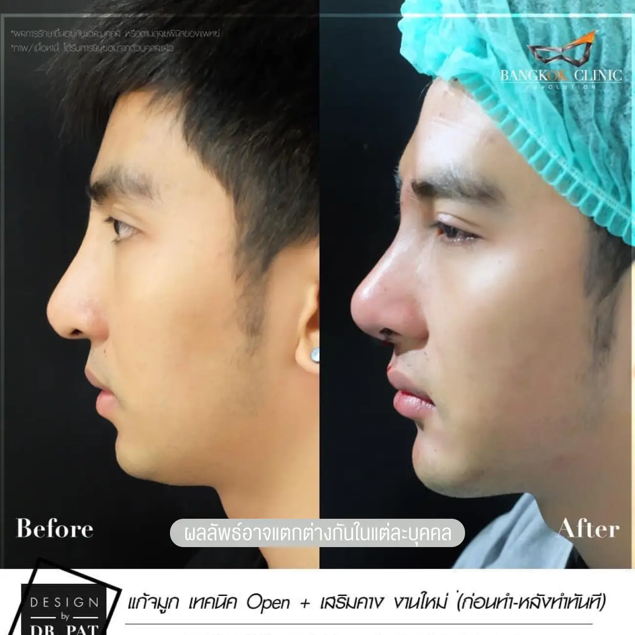 รีวิวทำคาง เสริมคางผู้ชาย ที่ Bangkok Clinic & Design by Dr. Pat รูปที่ 9