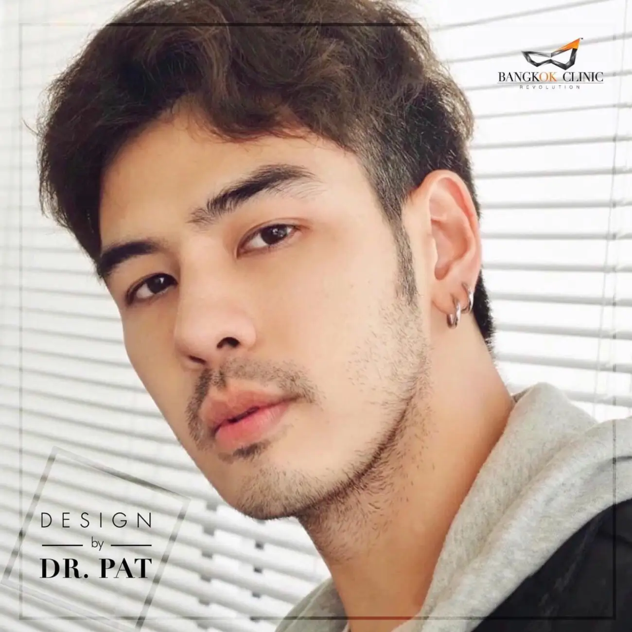 รีวิวทำจมูก เสริมจมูกผู้ชาย ที่ Bangkok Clinic & Design by Dr. Pat รูป 9