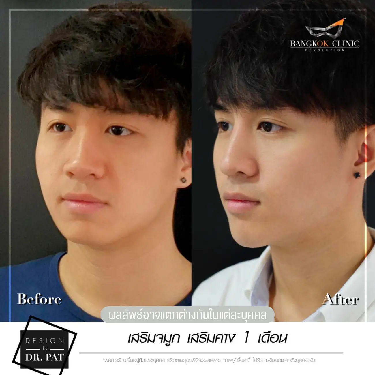 รีวิวทำคาง เสริมคางผู้ชาย ที่ Bangkok Clinic & Design by Dr. Pat รูปที่ 10