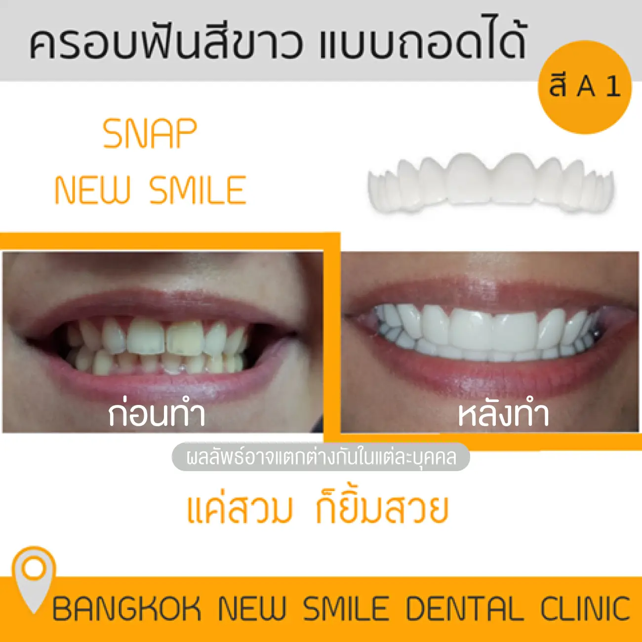 รีวิว Snap on ครอบฟันขาวแบบถอดได้ ที่ Bangkok New Smile Dental Clinic รูปที่ 1