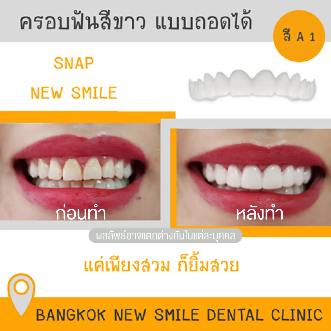 รีวิว Snap on ครอบฟันขาวแบบถอดได้ ที่ Bangkok New Smile Dental Clinic รูปที่ 2