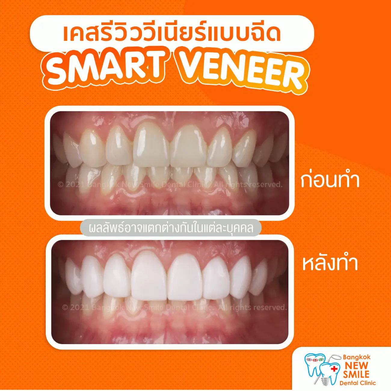 รีวิวทำวีเนียร์แบบฉีด ที่ Bangkok New Smile Dental Clinic รูป 1