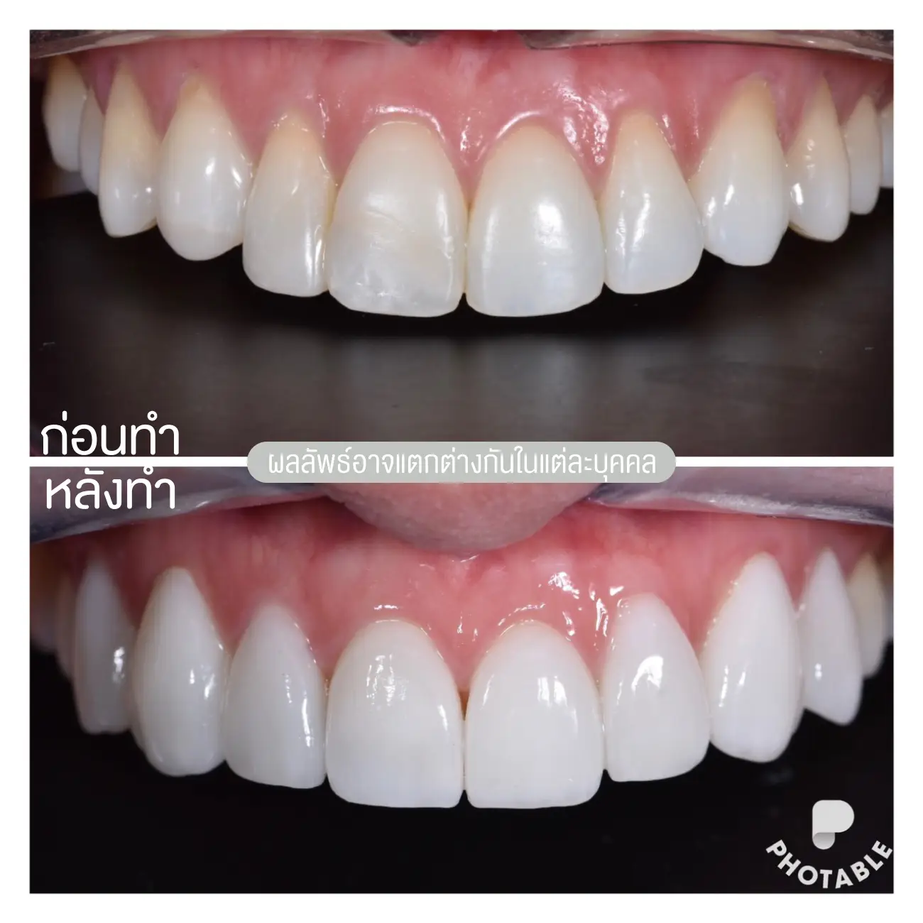 รีวิวเซรามิกวีเนียร์ (Ceramic Veneer) ที่ Bangkok New Smile Dental Clinic รูปที่ 1