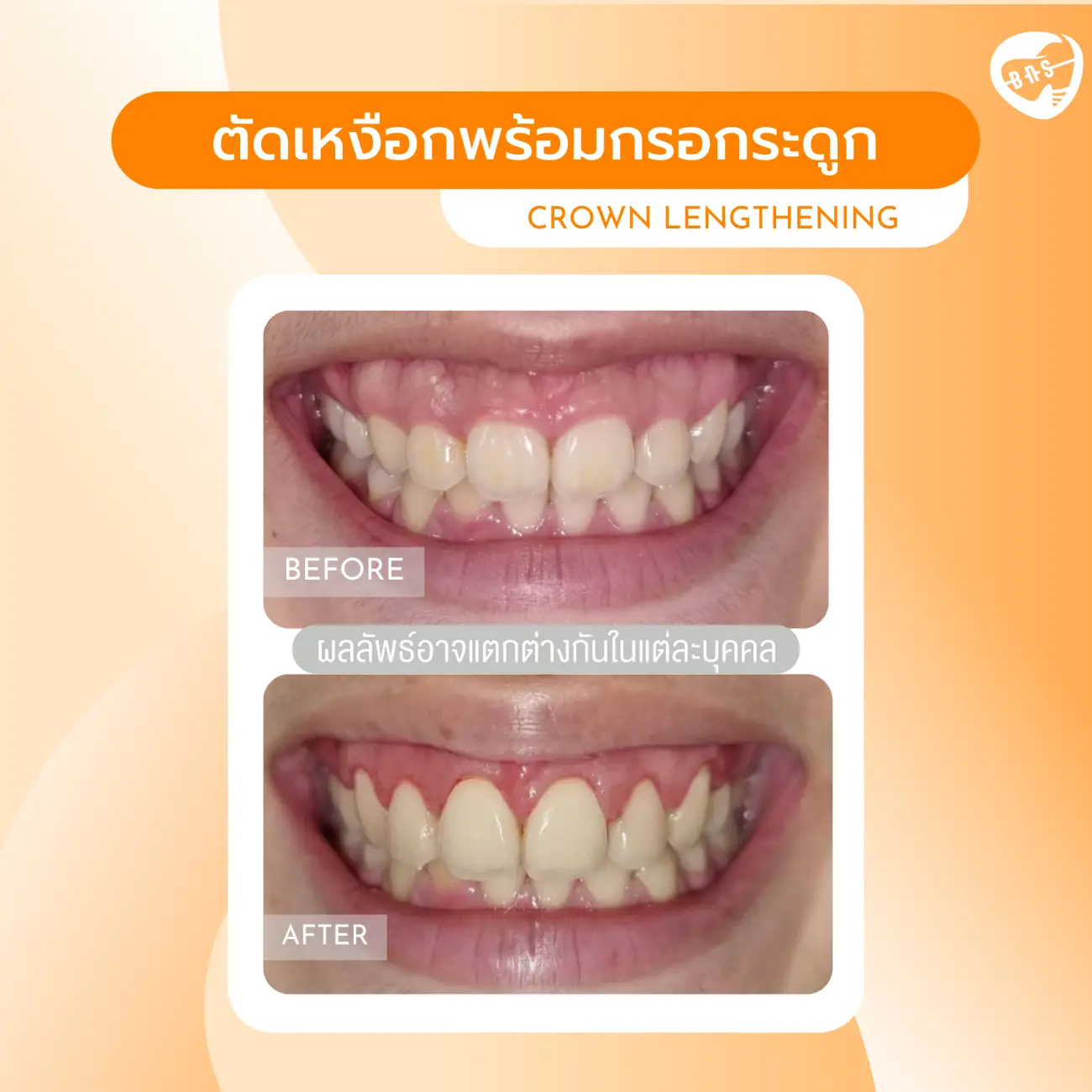 รีวิวตัดเหงือก ที่ Bangkok New Smile Dental Clinic รูปที่ 1