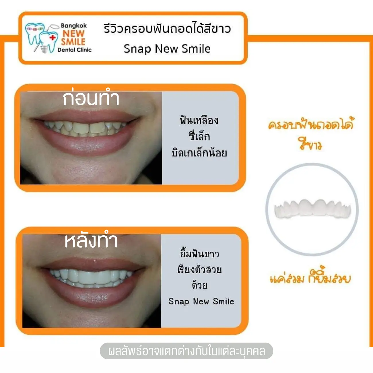 รีวิว Snap on ครอบฟันขาวแบบถอดได้ ที่ Bangkok New Smile Dental Clinic รูปที่ 3