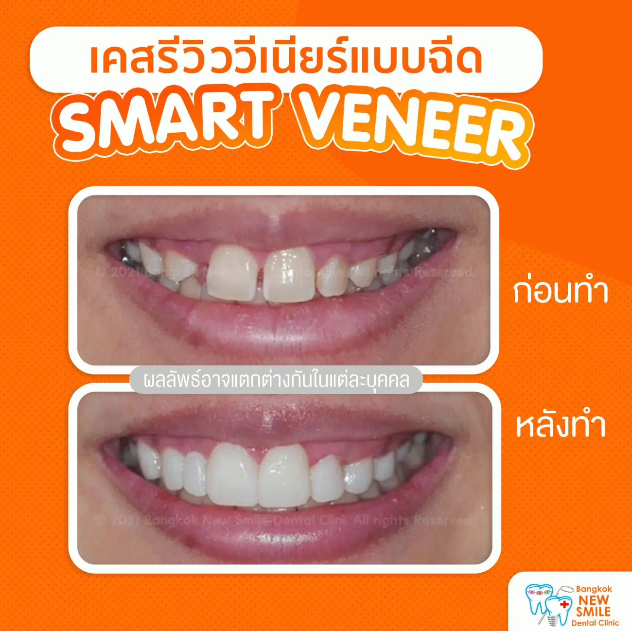 รีวิวทำวีเนียร์แบบฉีด ที่ Bangkok New Smile Dental Clinic รูป 2