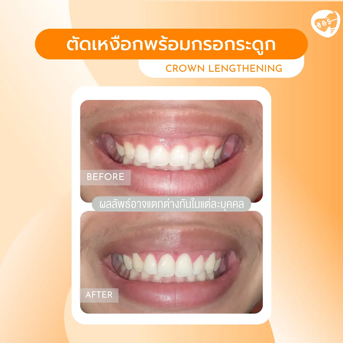 รีวิวตัดเหงือก ที่ Bangkok New Smile Dental Clinic รูปที่ 2