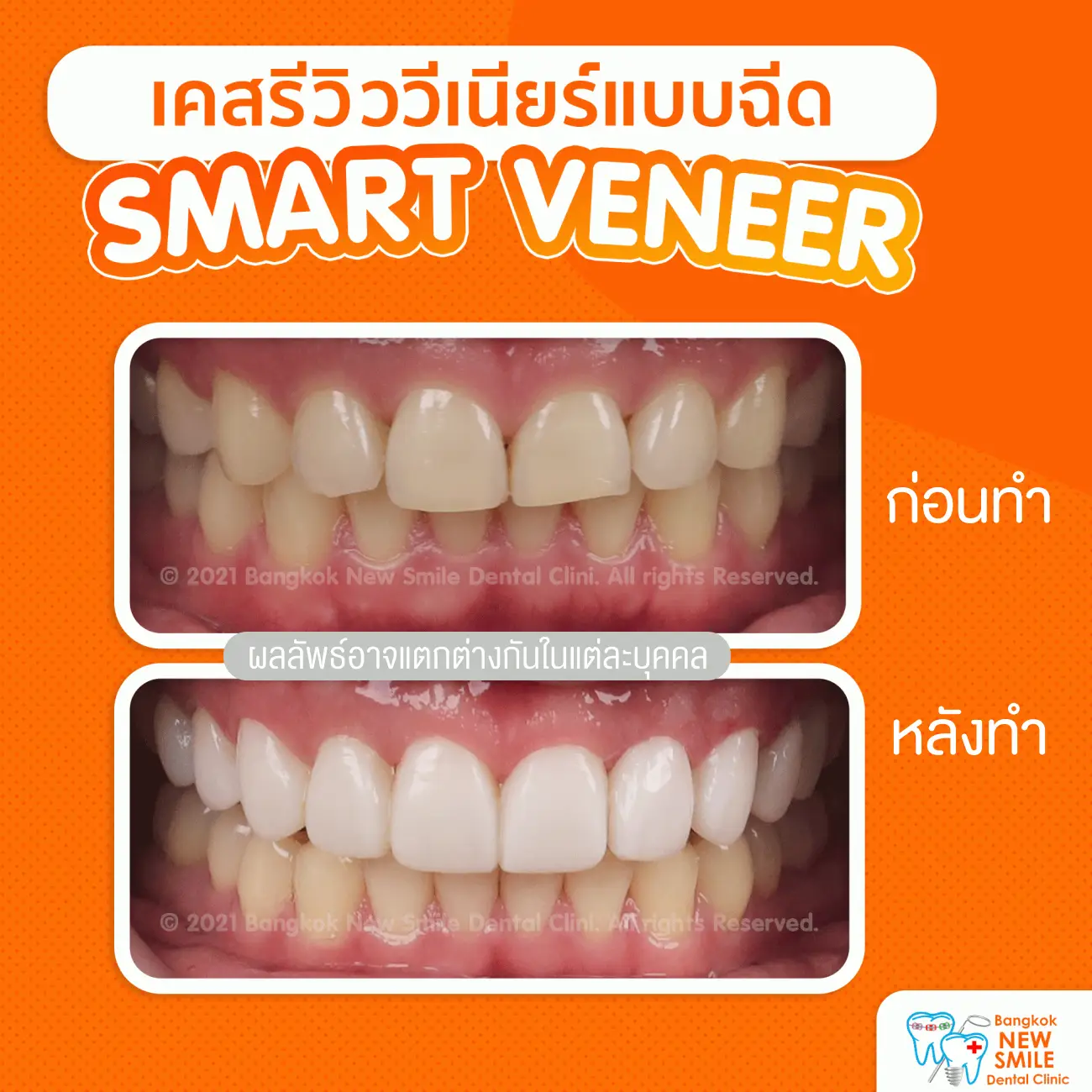 รีวิวทำวีเนียร์แบบฉีด ที่ Bangkok New Smile Dental Clinic รูป 3