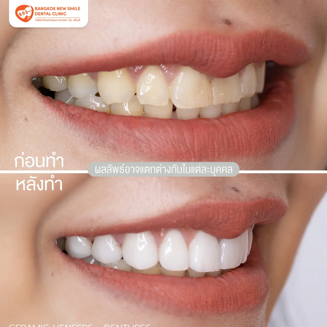 รีวิวเซรามิกวีเนียร์ (Ceramic Veneer) ที่ Bangkok New Smile Dental Clinic รูปที่ 3