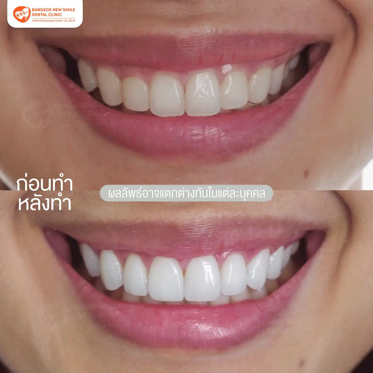 รีวิวเซรามิกวีเนียร์ (Ceramic Veneer) ที่ Bangkok New Smile Dental Clinic รูปที่ 4