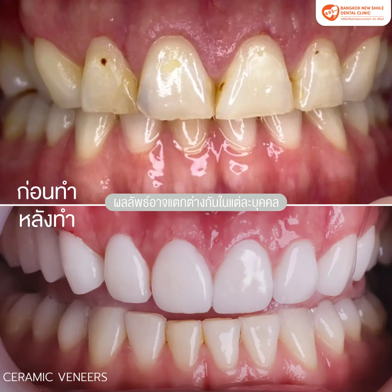 รีวิวเซรามิกวีเนียร์ (Ceramic Veneer) ที่ Bangkok New Smile Dental Clinic รูปที่ 5