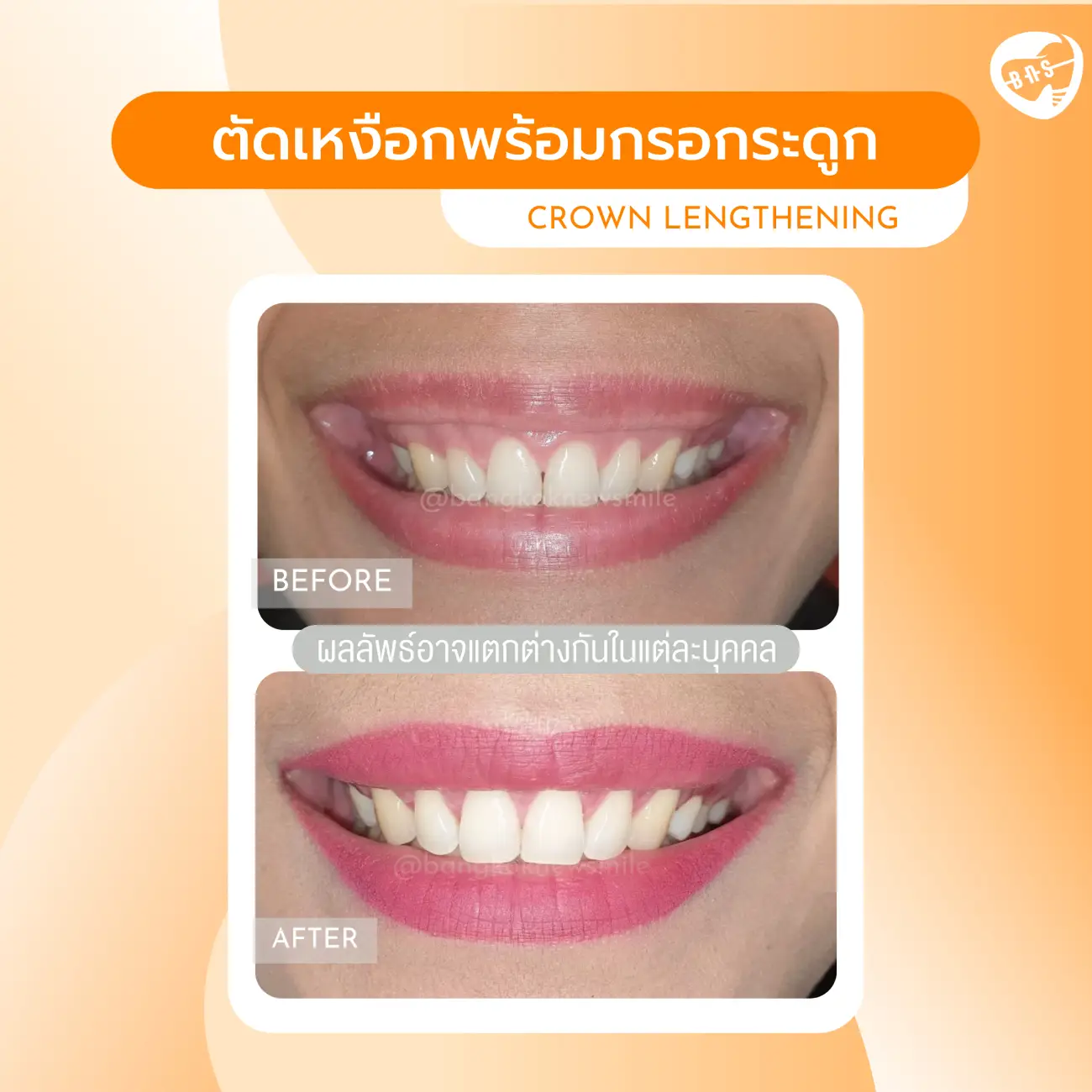 รีวิวตัดเหงือก ที่ Bangkok New Smile Dental Clinic รูปที่ 3