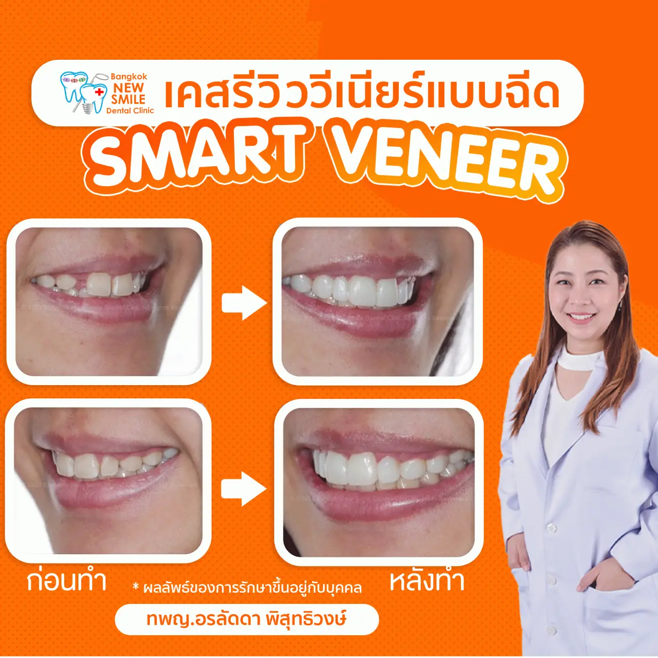 รีวิวทำวีเนียร์แบบฉีด ที่ Bangkok New Smile Dental Clinic รูป 4