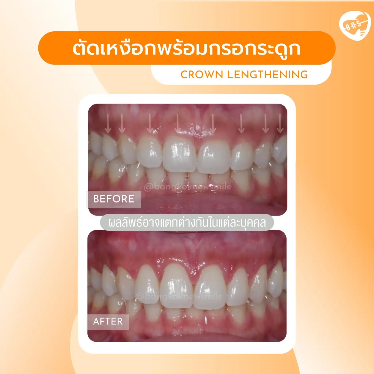 รีวิวตัดเหงือก ที่ Bangkok New Smile Dental Clinic รูปที่ 4