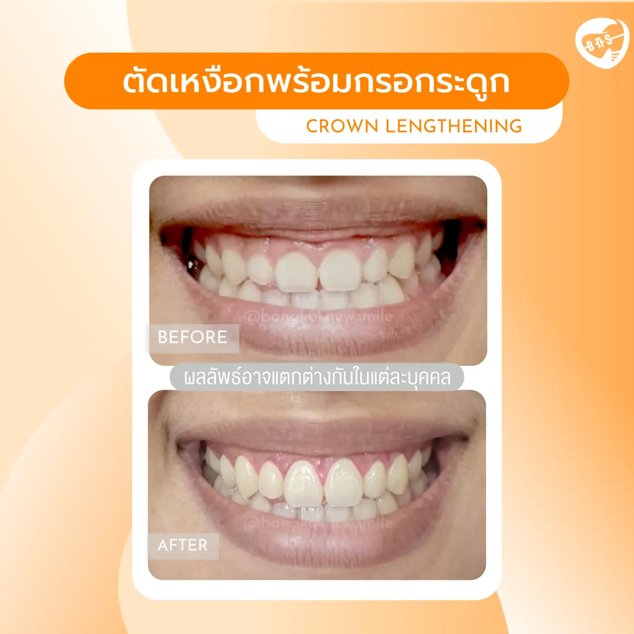 รีวิวตัดเหงือก ที่ Bangkok New Smile Dental Clinic รูปที่ 5