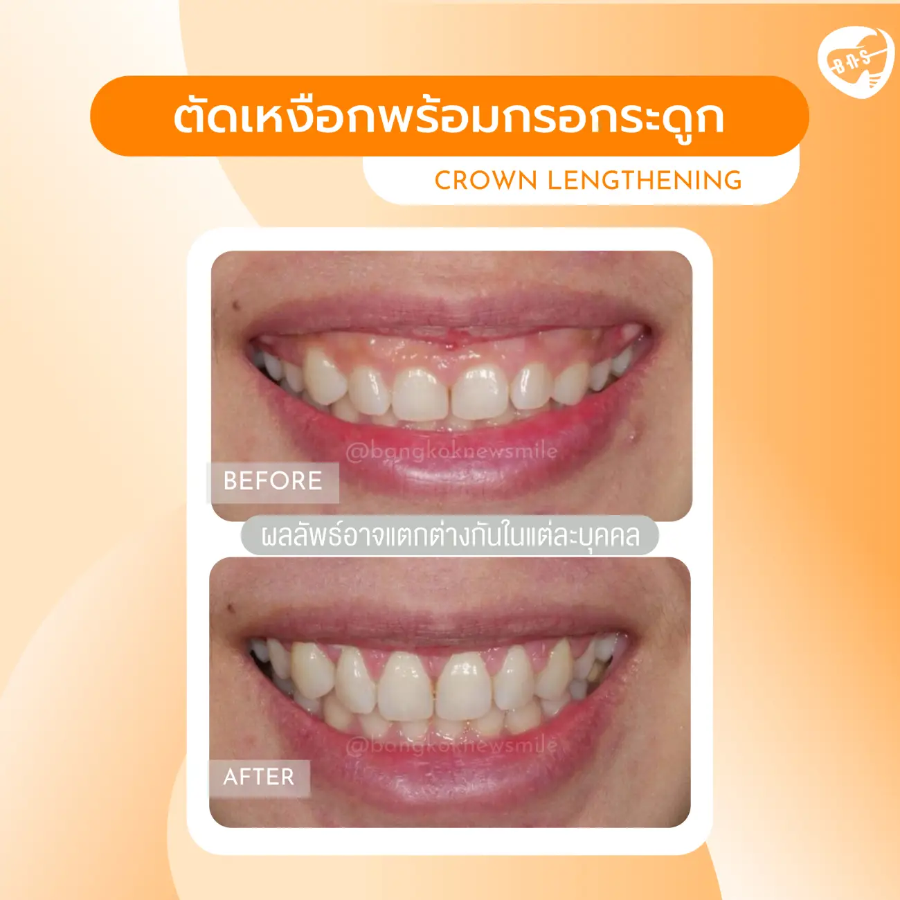 รีวิวตัดเหงือก ที่ Bangkok New Smile Dental Clinic รูปที่ 6