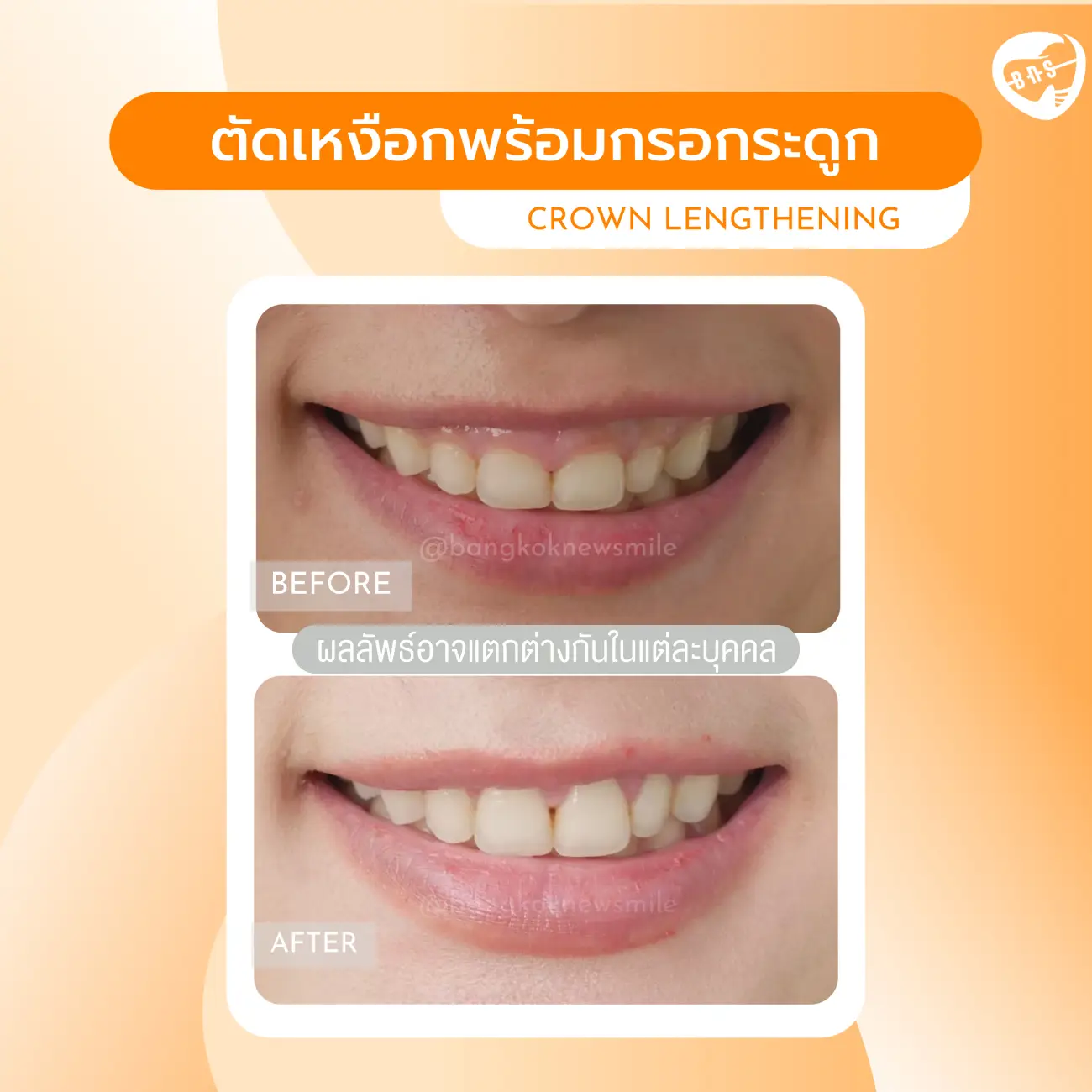 รีวิวตัดเหงือก ที่ Bangkok New Smile Dental Clinic รูปที่ 7