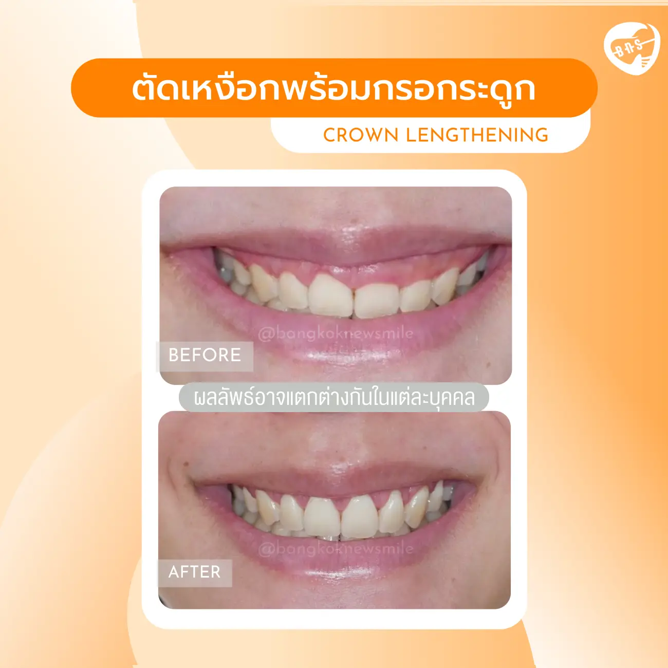 รีวิวตัดเหงือก ที่ Bangkok New Smile Dental Clinic รูปที่ 8