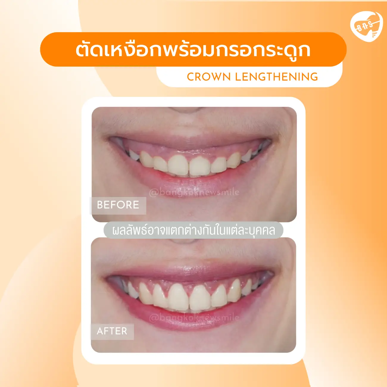 รีวิวตัดเหงือก ที่ Bangkok New Smile Dental Clinic รูปที่ 9