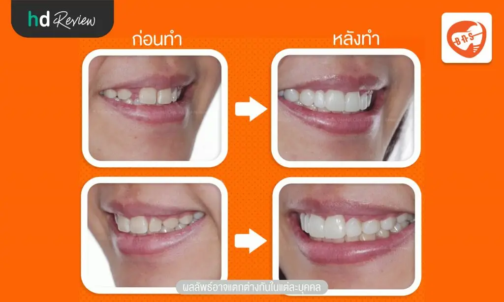 รีวิวทำวีเนียร์แบบฉีด ที่ Bangkok New Smile Dental Clinic