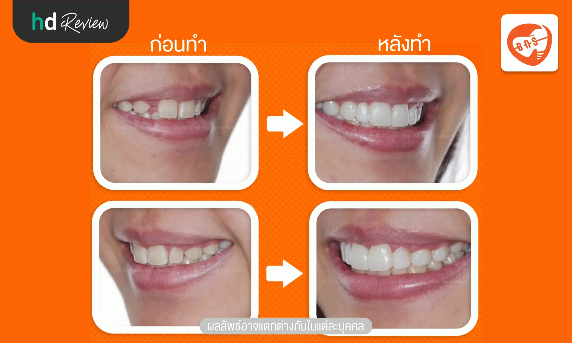 review before after Bangkok New Smile Dental Clinic hero 1