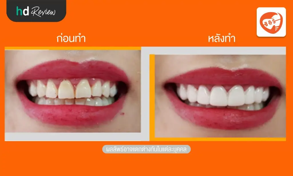 รีวิว Snap on ครอบฟันขาวแบบถอดได้ ที่ Bangkok New Smile Dental Clinic